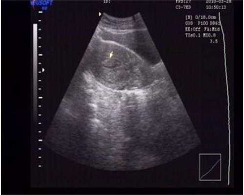 卵泡穿刺术要多少钱_卵泡穿刺疼不疼大概需要多久