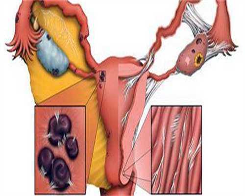 宫颈鳞癌ib1影响正常寿命吗